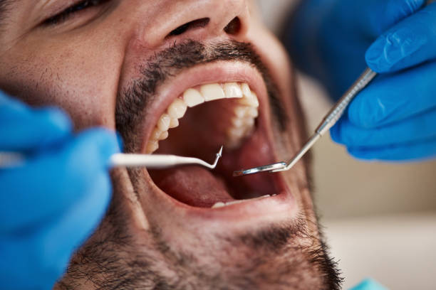 Best Broken or Cracked Tooth Emergency Dentist in Advance, MO
